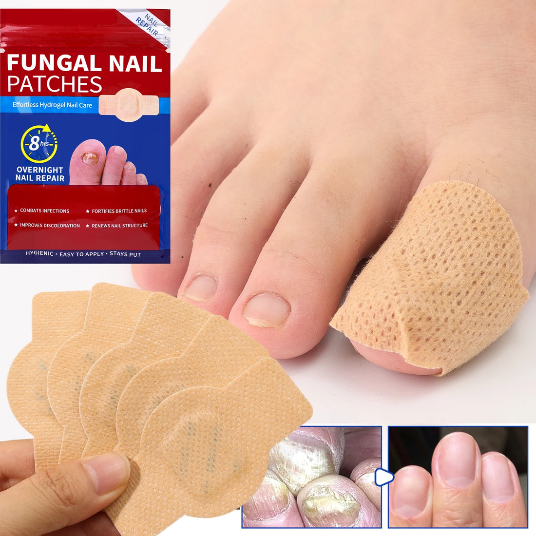 Toenail Repair Patches Set | Skelblum